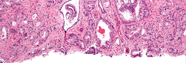 Cancer_Prostata