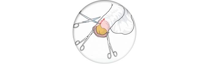circuncisión en edad avanzada