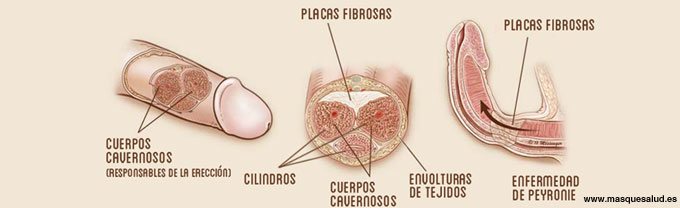 Cirugía de desviación de pene