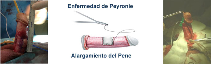 Chirurgical procedures