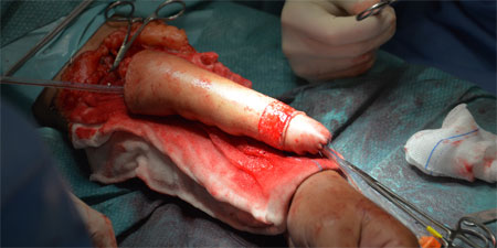 Neofalo intervención