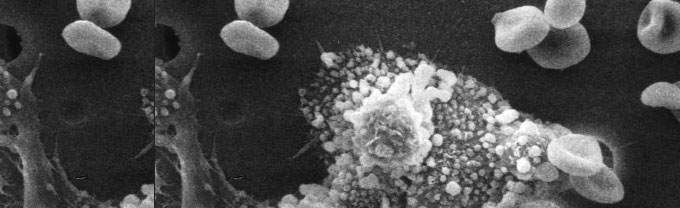 OBESIDAD Y CÁNCER DE PRÓSTATA