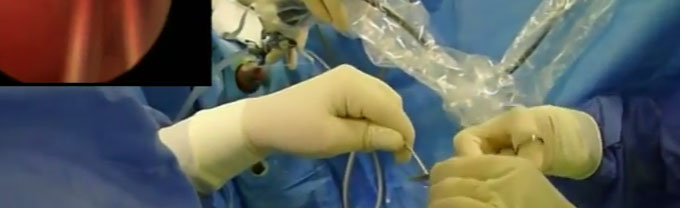 STENT UROLÓGICO TEMPORAL (ITIND)