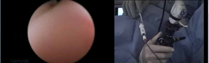 botox incontinencias