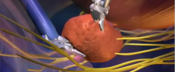 cáncer de próstata