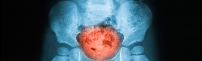 cáncer de vejiga