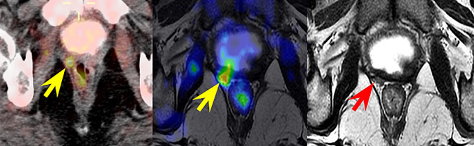 cáncer de próstata