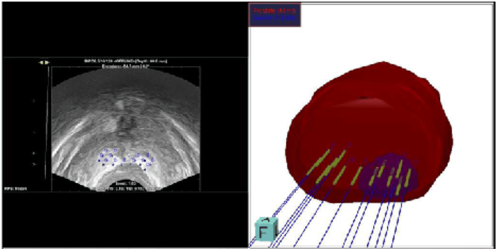 terapia focal cáncer de próstata