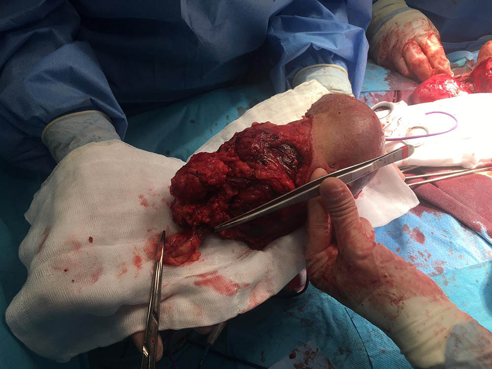 tumor testicular cáncer