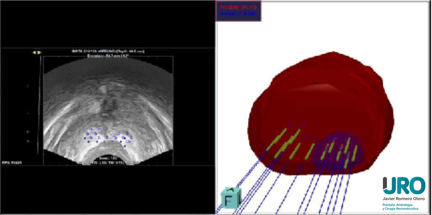 cancer-prostata-terapia-focal