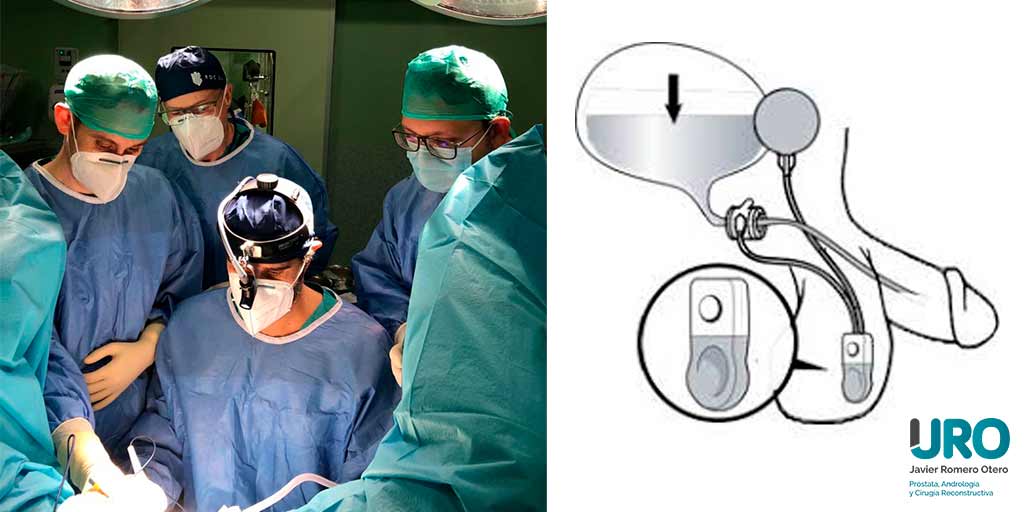 Esfínter urinario cirugía reconstructiva