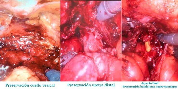 Cirugía robótica cáncer próstata