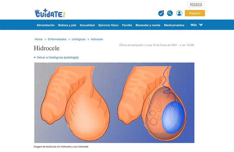 causas del hidrocele